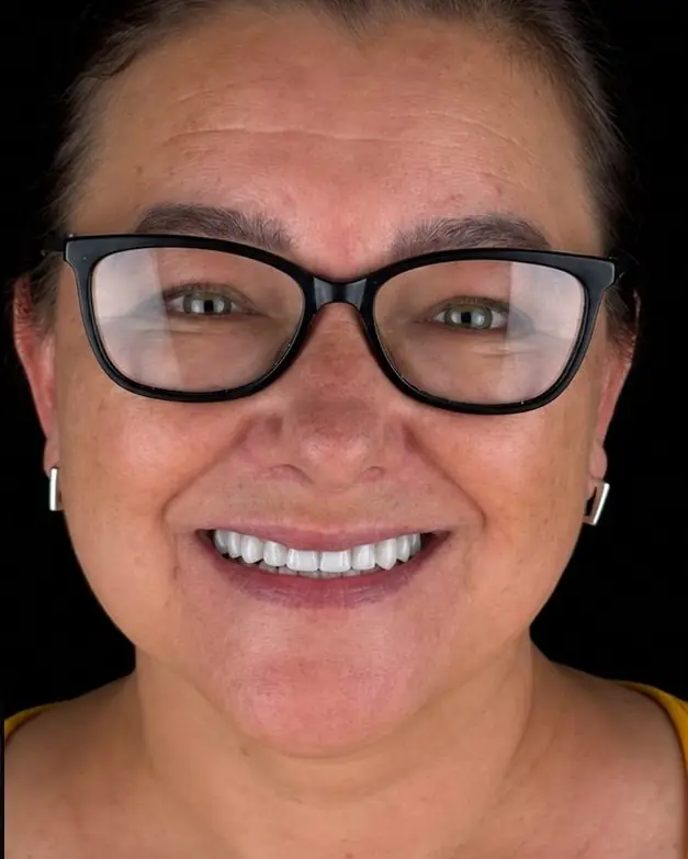 Reabilitação oral completa, depois do tratamento