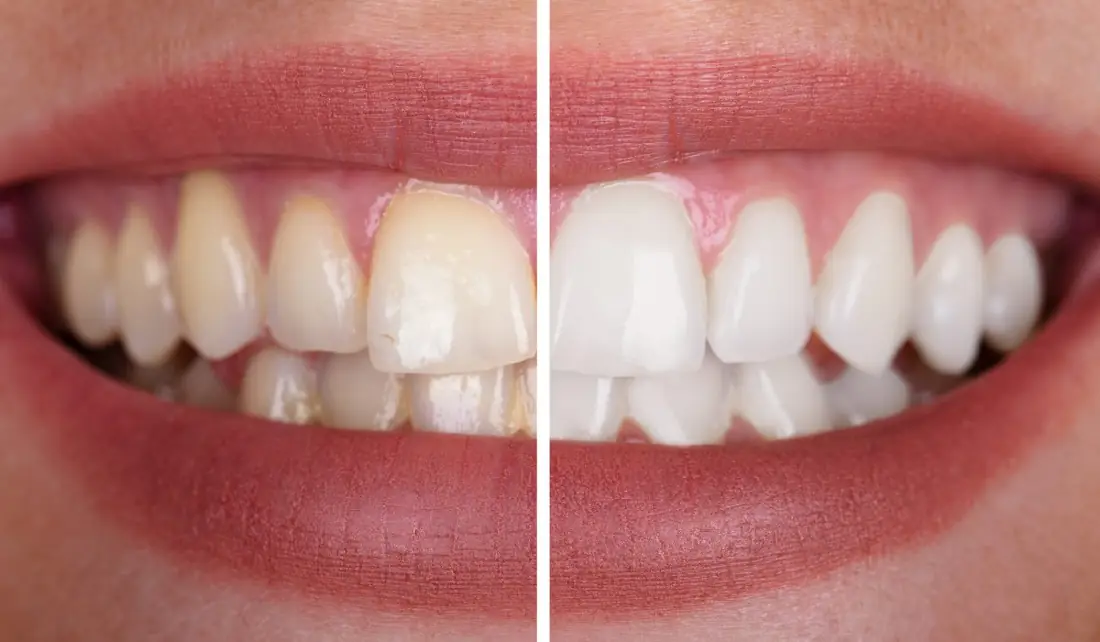 Clareamento Dental
