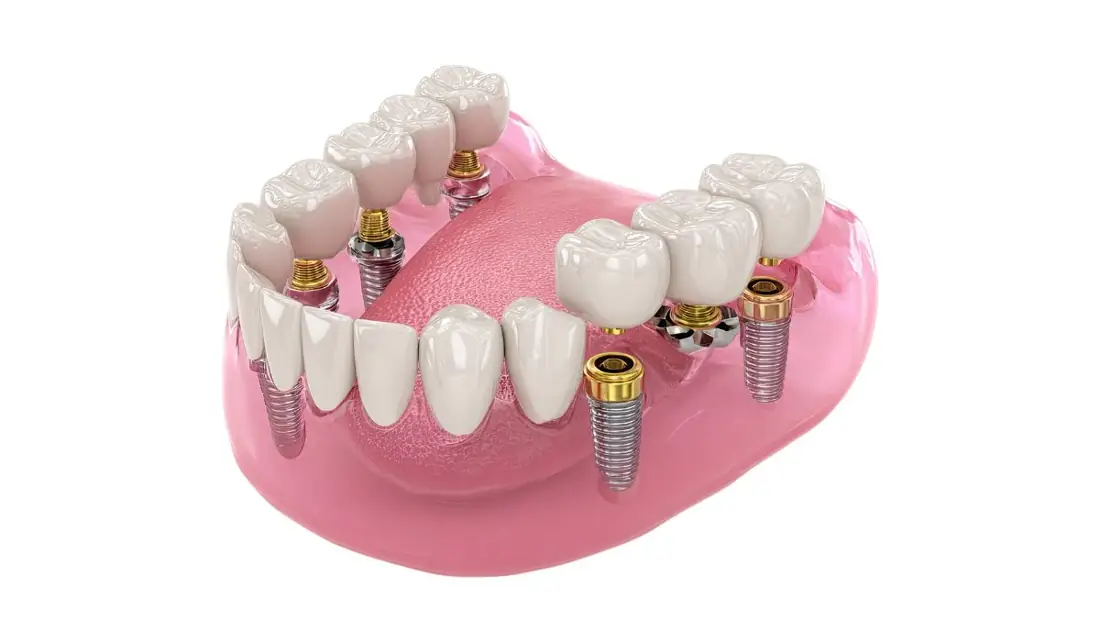 Implantes Dentários